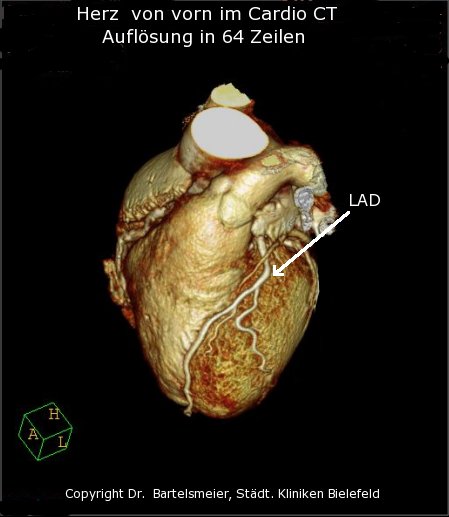 Herz Cardio_CT in 3D