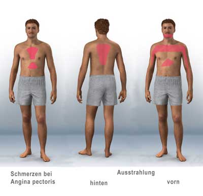 Angina Lokalisation