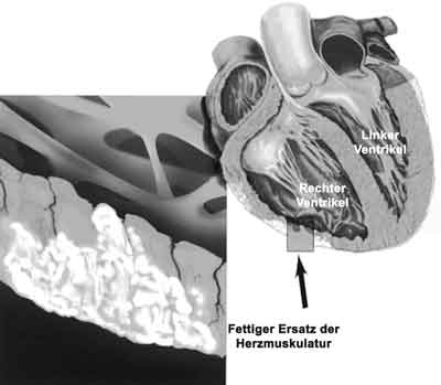 Bild ARVCM anatomisch