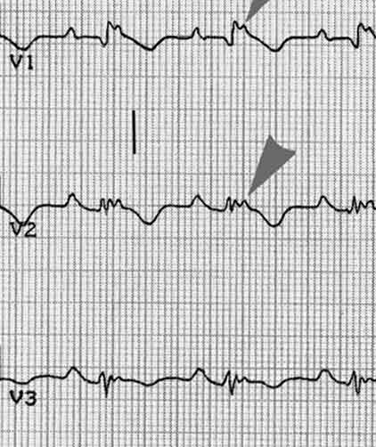 EKG tyisch ARVCM