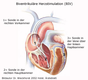 Biventrikulärer Schrittmacher