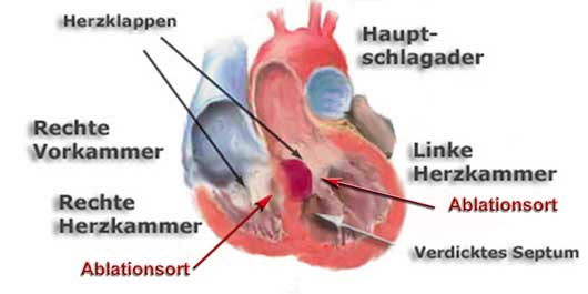 Herz Erash Bild