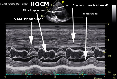 M-mode HOCM