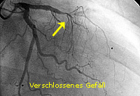 Infarkt_PTCA_1_ Verschlossenes Gefäß