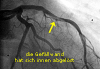 Infarkt_PTCA_4_Dissektion der Gefässwand 