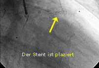 Infarkt_PTCA_7_der Stent ist plaziert 