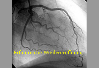 Infarkt_PTCA_8_erfolgreiche Wiedereröffnung 