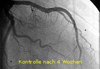 Infarkt_PTCA_9_Befundkontrolle nach 4 Wochen 