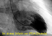 nfarkt_PTCA_11_LV_diastolich vorher