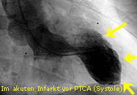 nfarkt_PTCA_12_LV systolisch vorher