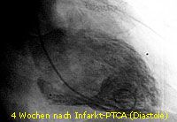 nfarkt_PTCA_13_LV distolisch nach 4 Wochen 