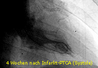 nfarkt_PTCA_14_LV systolisch nach 4 Wochen 