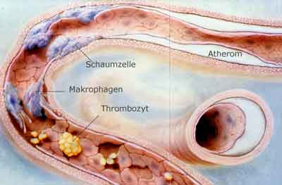 Bild Entstehung der Koronarstenose
