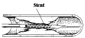 Bild Stent gefaltet