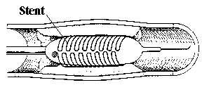 Bild Stent Übersicht